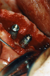 Rescate de implantes