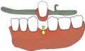 Dentadura parcial removible