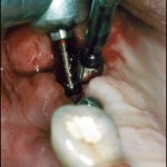 Extracción de Implantes