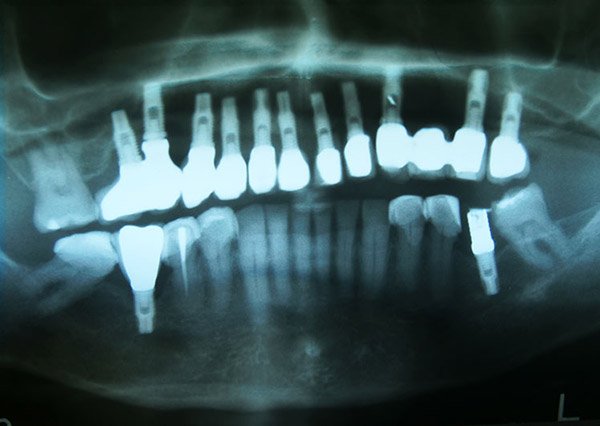 radiografia implantes bucales